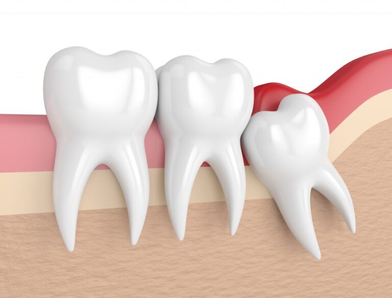 Your Complete Guide to Wisdom Tooth!