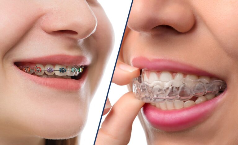 How To Choose Between Invisalign and Braces