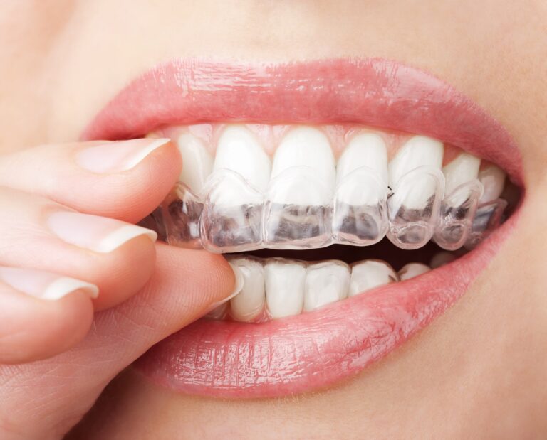 The Benefits of Invisalign for Orthodontic Treatment