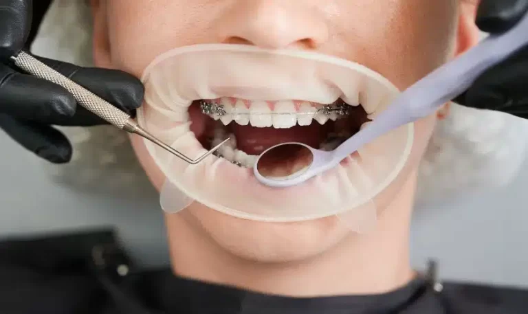 Cosmetic Dentistry: The Function of Dental Implants in Perth