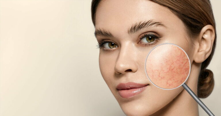 Calm Rosacea with Targeted and Effective Treatment Solutions